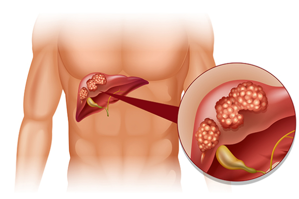 liver tumor treatment in pune