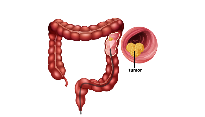 Colorectal Treatment in Pune