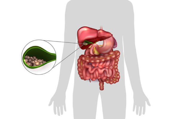 Gall Stone Removal Treatment in Pune