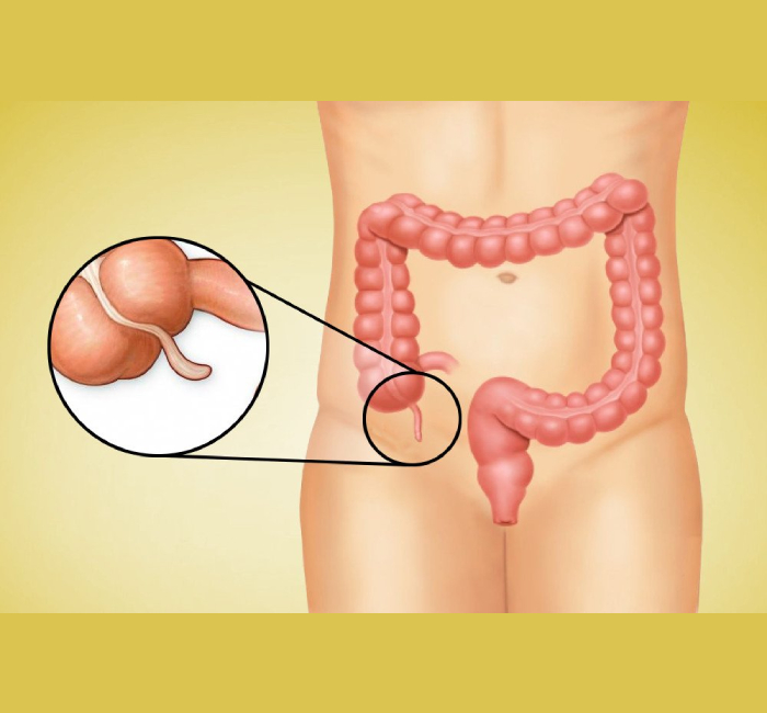 Appendix Removal Treatment in Pune