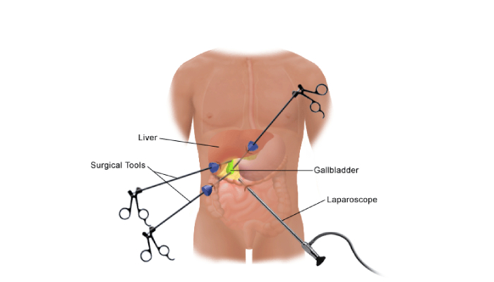 Cholecystectomy Surgery Treatment in Pune