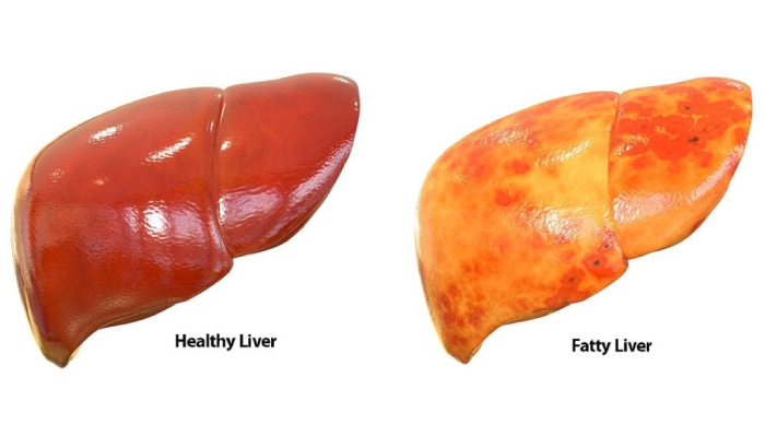 Fatty liver treatment in pune