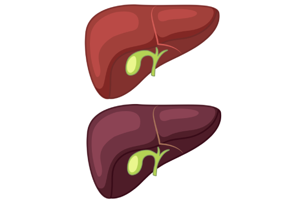 Cirrhosis Treatment in Pune