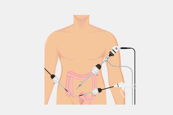 Laparoscopic Appendix Surgery in Pune