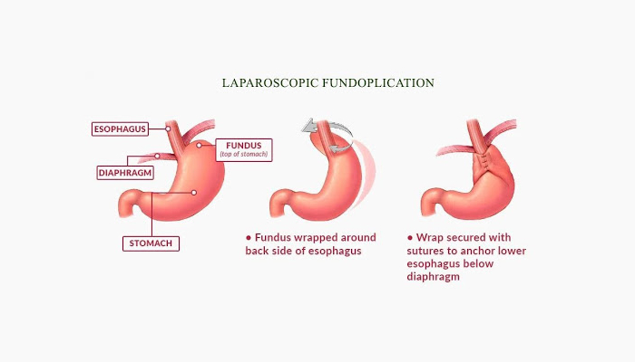 Laparoscopic Fundoplication Surgery in Pune