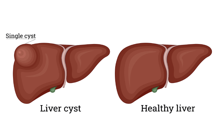 Liver Cyst Removal Surgery & Treatment in Pune