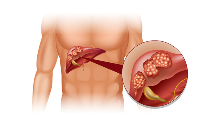 Liver Diseases Treatment in Pune