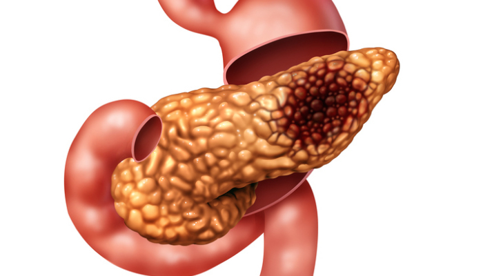 Pancreatic Cancer Treatment in Pune