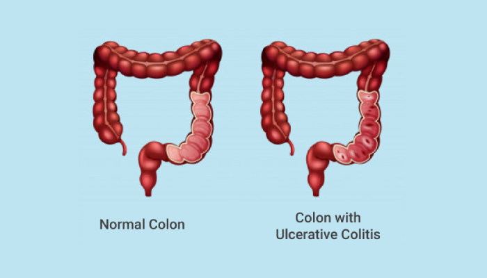 Ulcerative Colitis Treatment in Pune